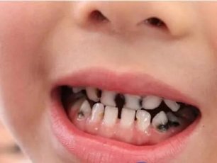 5歲孩子(zi)滿口黑牙，醫生：請别再坑娃了！